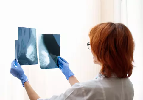 Zero mamografii decontate în nouă județe din țară anul trecut. În Suceava, peste o sută de femei au murit de cancer la sân în 2020