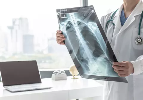 Mic ghid al pacientului în fața cancerului bronho-pulmonar - de la diagnostic la strategii de tratament