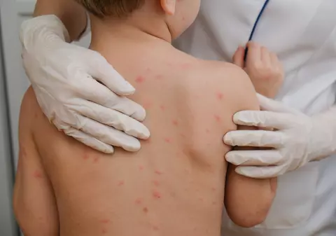 Ministerul Sănătății a declarat epidemie de rujeolă în România. Aproape 2.000 de cazuri înregistrate în 29 de județe