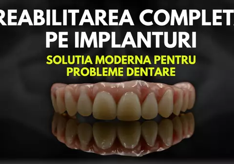 O Soluţie Modernă pentru Probleme Dentare: Reabilitarea Completă cu Implanturi