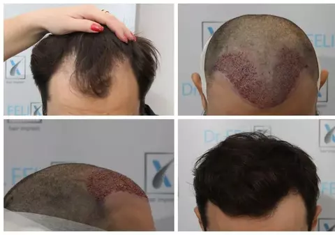 Te-ai gândit că o decizie îți poate schimba look-ul? Informații despre tehnica Q-FUE aici ai