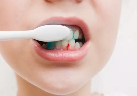 Parodontoza, boala care poate cauza pierderea dinților