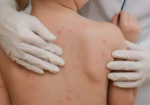 Creştere bruscă a numărului de cazuri de rujeolă în Europa, avertizează OMS