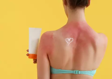 Sfaturi și remedii eficiente pentru arsuri solare