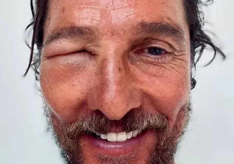 Matthew McConaughey și-a îngrijorat fanii după ce a apărut cu ochiul umflat. Ce a pățit actorul