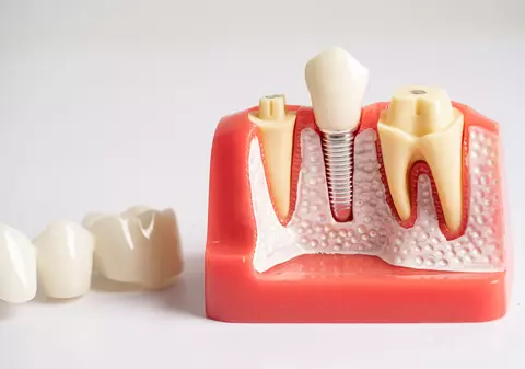 Avantajele implantului dentar: care sunt beneficiile?
