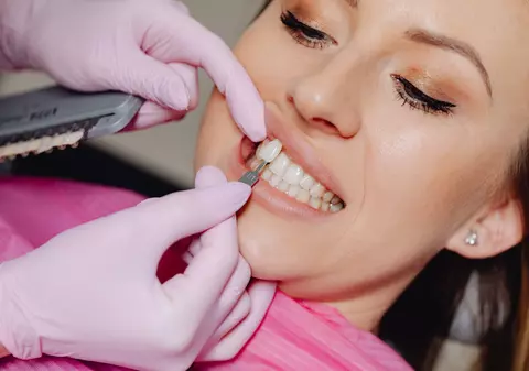 Cum să alegi nuanța potrivită pentru fațetele dentare