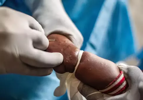 Mpox, cunoscută ca „variola maimuței”, nu este noul COVID, spune un oficial OMS