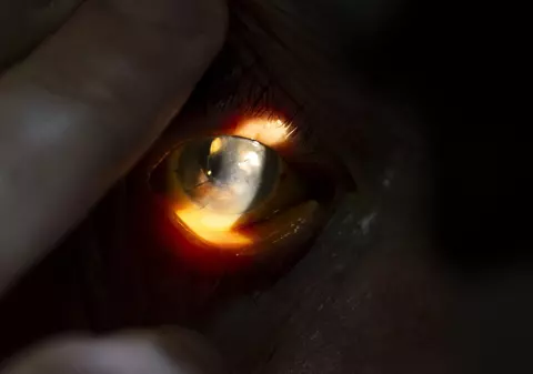 Corneea artificială hibridă, invenția care revoluționează medicina. Primele trei transplanturi au avut rezultate pozitive 