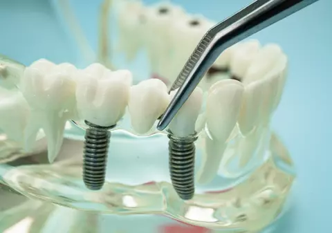 Avantajele implanturilor dentare: O soluție durabilă pentru un zâmbet sănătos