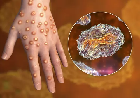 Primul caz de infectare cu noua variantă a virusului mpox, variola maimuței, confirmat în Germania