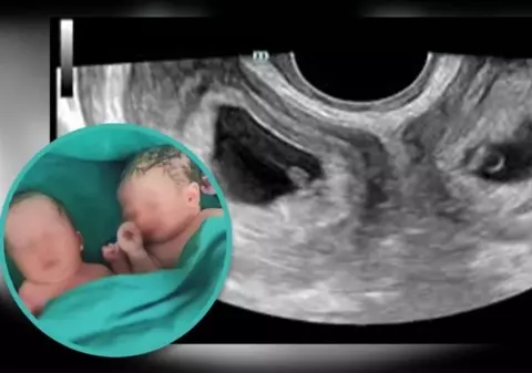 O femeie cu două utere a născut gemeni. „Un caz la un milion”, a anunțat spitalul din China