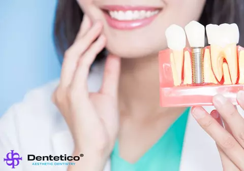 Ghid complet pentru îngrijirea dinților după un implant dentar