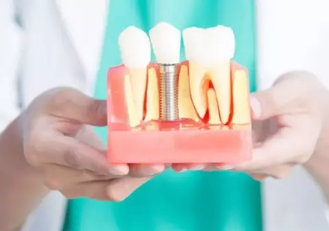 Cât costă o proteză fixă cu 4 sau 6 implanturi? Tot ce trebuie să știi despre această soluție modernă de reconstrucție dentară