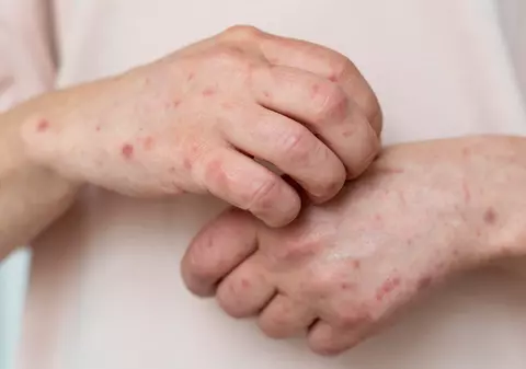 Noua variantă de Mpox a ajuns în Franța: „Acest lucru necesită vigilență și prudență”
