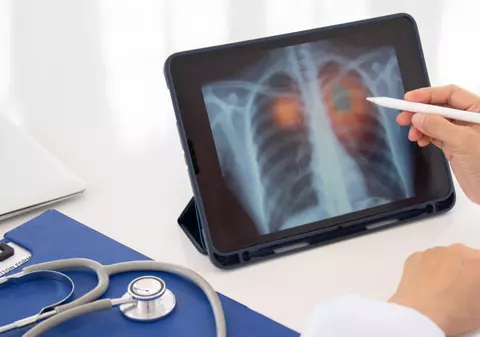 Cancerul pulmonar, din ce în ce mai frecvent printre nefumători. „Poluarea aerului, un factor important”