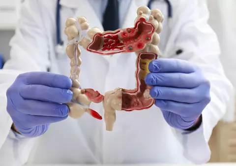 Alimentul accesibil care reduce riscul de cancer de colon. Expert: „Consumat regulat, are un efect protector”