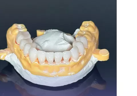 Implant dentar într-o zi? Află dacă ești candidatul ideal