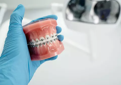 Mituri despre aparatele dentare
