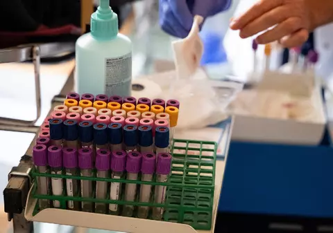 Testul de sânge revoluționar care detectează cancerul cu câțiva ani înainte ca simptomele să apară