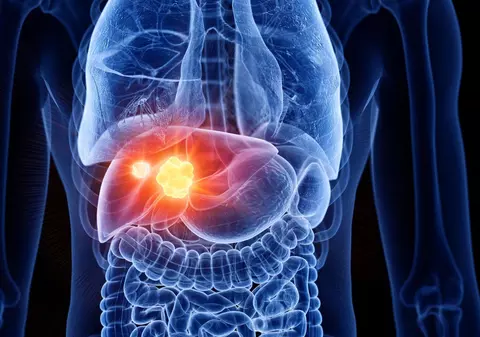 Cazurile de cancer hepatic aproape că se vor dubla la nivel mondial până în 2050