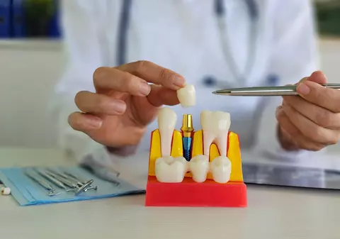 6 avantaje ale implantului dentar