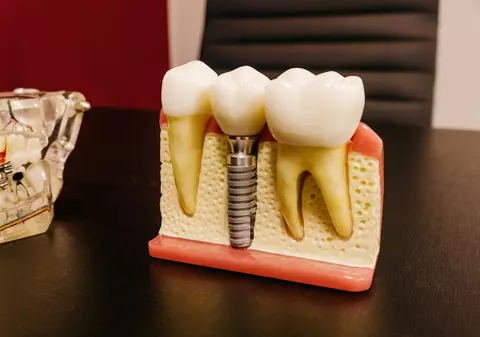 5 avantaje ale implantului dentar