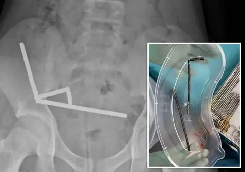 Băiat de 13 ani, operat de urgență după ce a înghițit 100 de magneți cumpărați de pe Temu