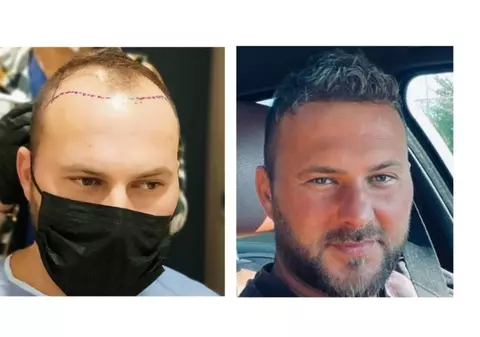 Top 5 Cele Mai Bune Clinici de Transplant de Păr din Turcia: Ghid de Selecție Profesional pentru Rezultate Superioare și Îngrijire Completă