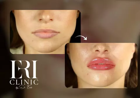 Dăruiește frumusețe: injectarea cu acid hialuronic la Eri Clinic din București, super cadoul dorit