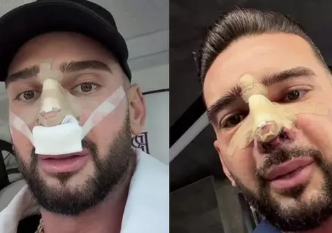 Cum arată nasul lui Dorian Popa la 12 zile de la operație. Și-a dat bandajul jos: „Cum nici nu am visat”