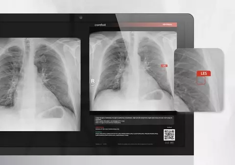 Revoluția silențioasă din radiologia pulmonară care salvează vieți în fiecare zi