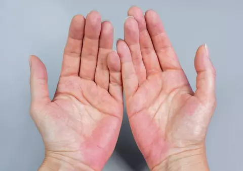 Ce semnificație are culoarea palmelor - ce probleme medicale pot indica