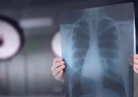 O femeie a fost operată de cancer pulmonar, deși era sănătoasă: „Diagnosticul de tumoră a fost stabilit în mod pripit”