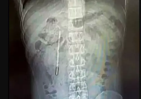 Medici șocați de ce au descoperit în stomacul unui bărbat internat cu dureri abdominale groaznice, în China: „Era acolo de 20 de ani”