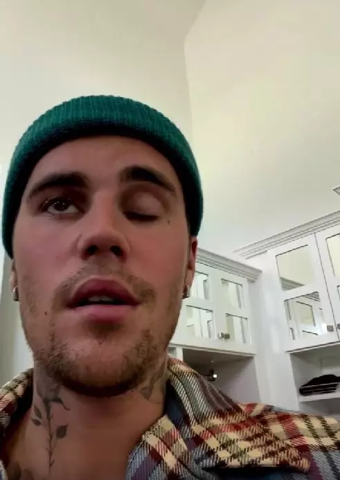 justin-bieber-sindromul-ramsay-hunt-2