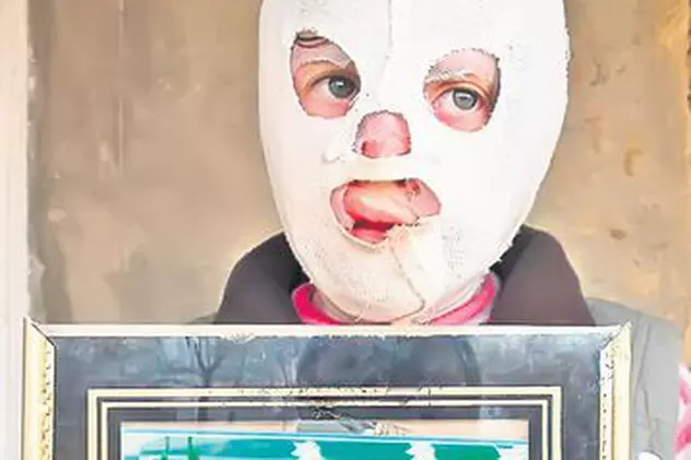 O fetiţă de 10 ani, care a suferit arsuri grave, e condamnată să poarte mască