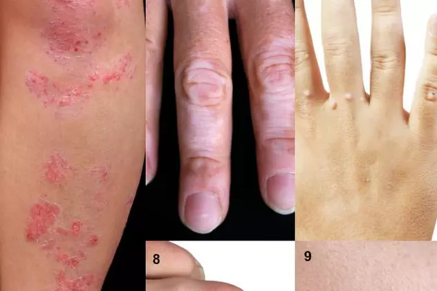 Cât de contagioase sunt, de fapt, bolile de piele?