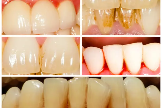 7 probleme dentare şi simptomele lor