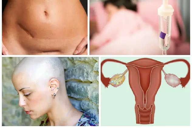 Cancerul ovarian – vezi care sunt simptomele!
