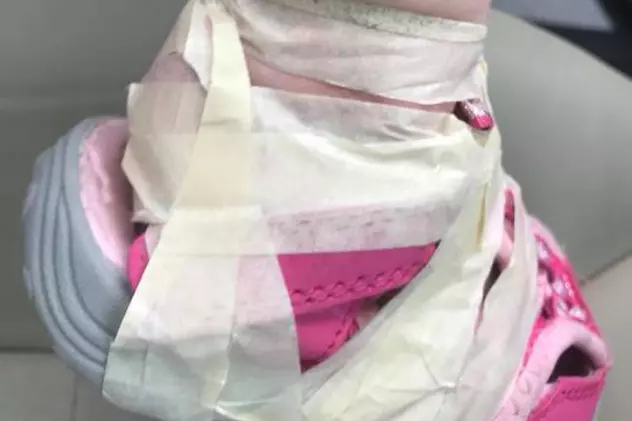 FOTO | Angajații unei creșe i-au lipit unei fetițe pantofii de picioare lăsând-o plină de răni