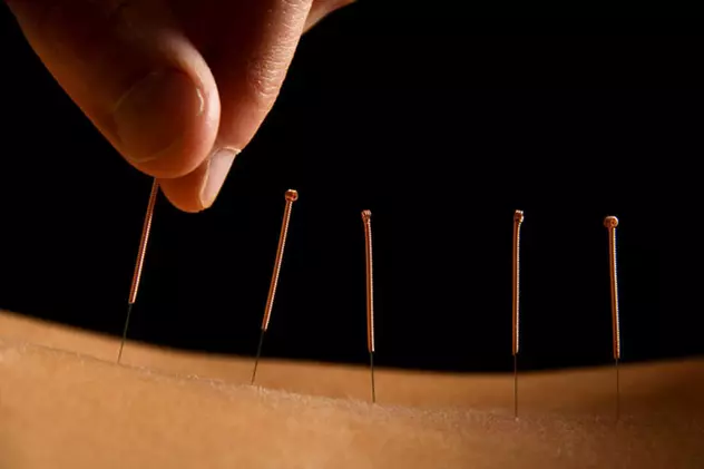 (P) Ce afecțiuni pot fi tratate într-un cabinet de acupunctură ?