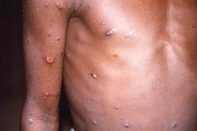 OMS anunță că nu este nevoie urgentă de vaccinare în masă contra variolei maimuței