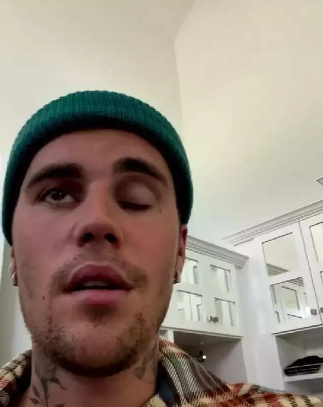 justin-bieber-sindromul-ramsay-hunt-2