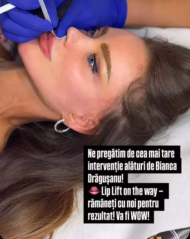 bianca dragusanu operatie estetica lip lift (4)