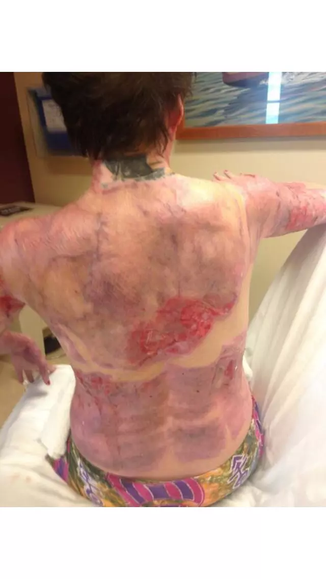 Suicide Burns Survivor ***EXCLUSIVE***