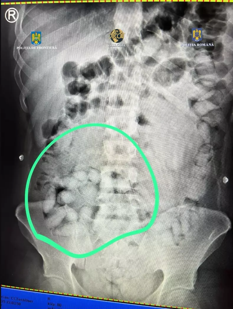 brazilian-cocaina-stomac-lipita-picioare-prins-otopeni3