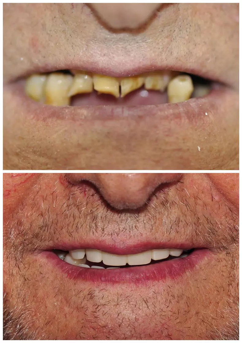 Probleme cu dantura la bătrânețe