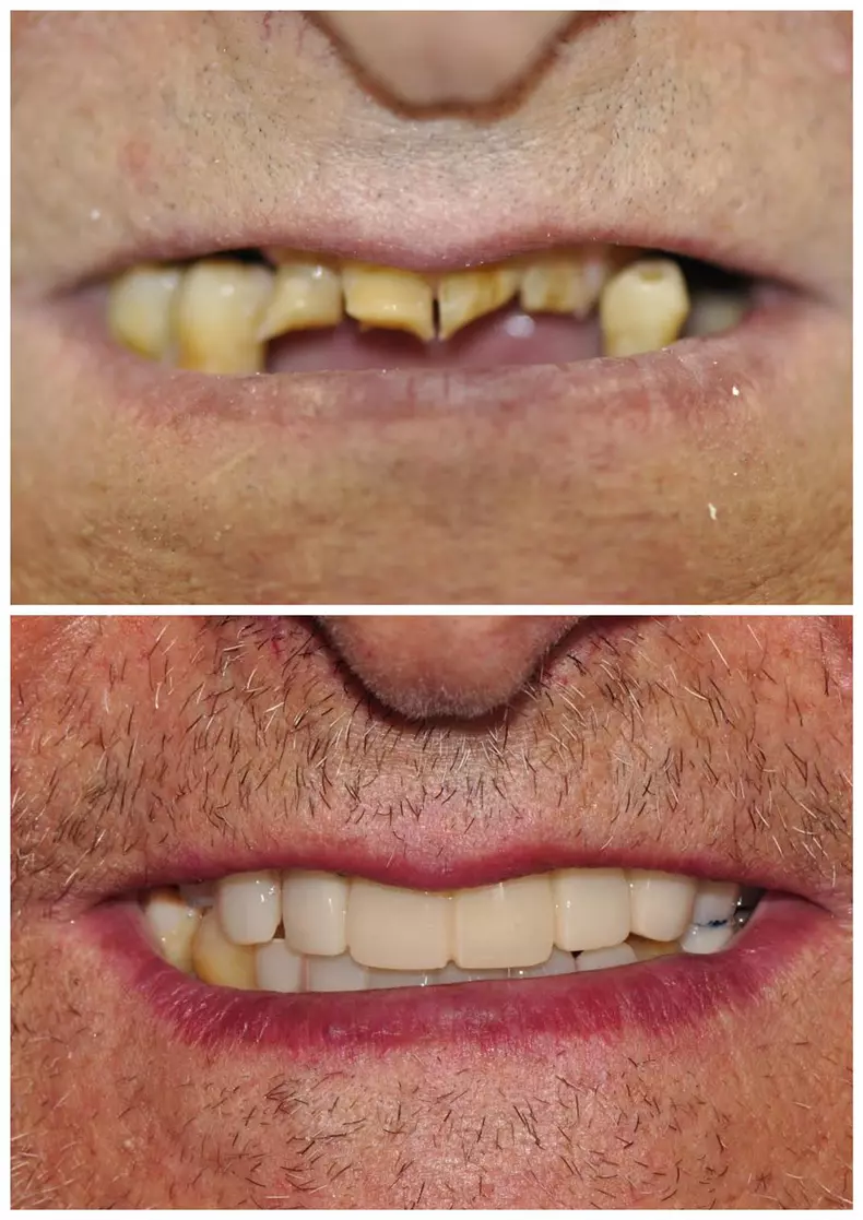 Probleme cu dantura la bătrânețe