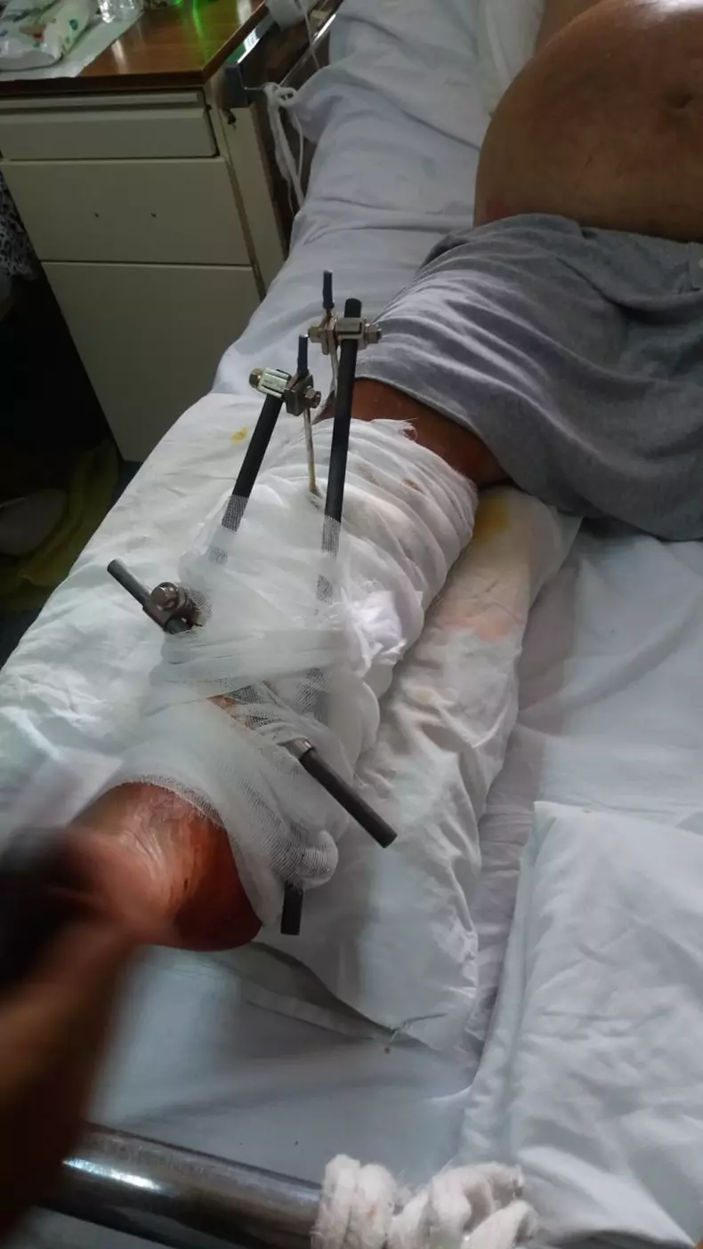 Berindei Marian zis Bucșă a stat în spital cu piciorul drept prins în tije